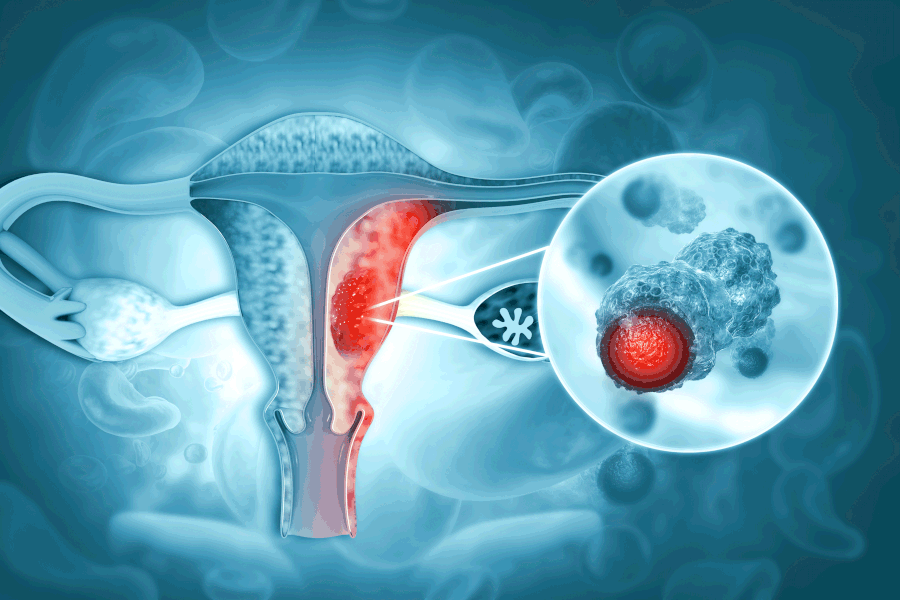 endometrial cervical cancer symptoms