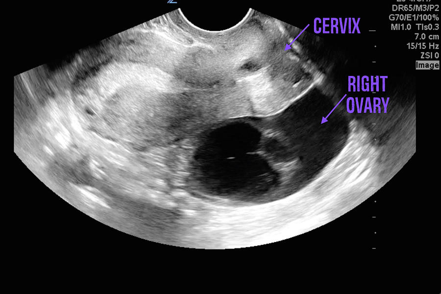 pelvic inflammatory disease